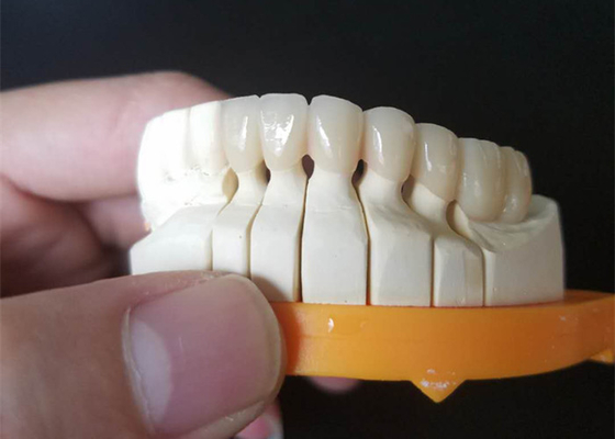 Coronas de cerámica de encargo del tamaño PFM para los dientes posteriores y anteriores