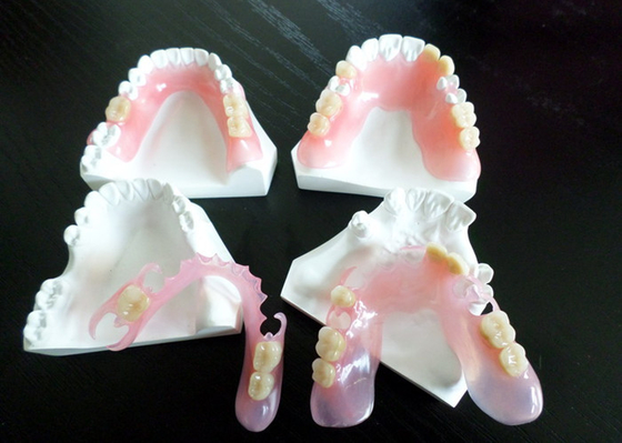 Restauración dental de la corona de Digitaces PFM
