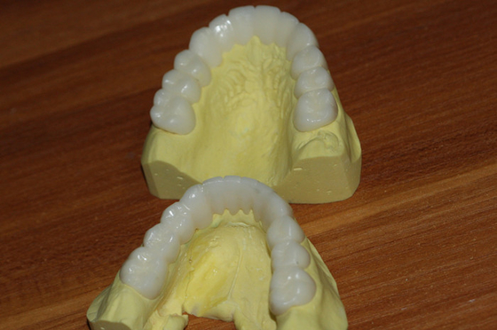 Corona dental temporal de PFM