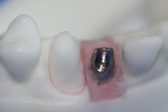 Contrafuerte de encargo del titanio de la barra pura desprendible del implante dental