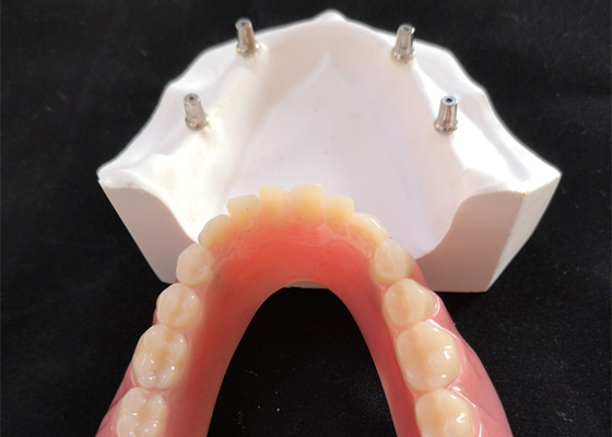 El implante dental cómodo Overdenture de la leva del cad fácil mantiene