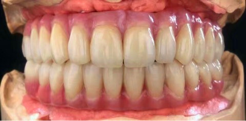 Coronas y puentes de dientes totalmente cerámicos de zirconia