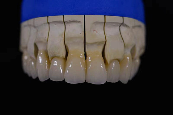 Laboratorio de fabricación de dentaduras obtención de dentaduras perfectamente blancas con reparación de zirconia