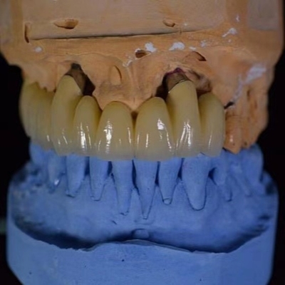 La porcelana de la corona del FDA PFM se fundió a la corona del metal