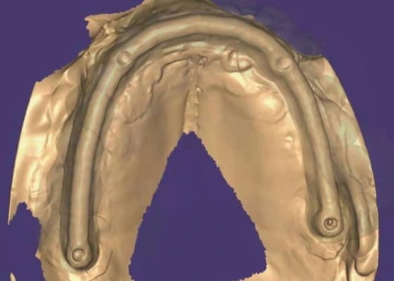 Coronas dentales de zirconia: dientes de aspecto natural, duraderos y seguros