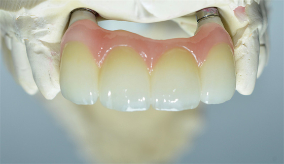 Base fuerte del Ti que muele el puente apoyado diente de las coronas del implante dental