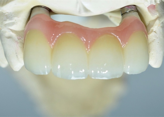 Base fuerte del Ti que muele el puente apoyado diente de las coronas del implante dental