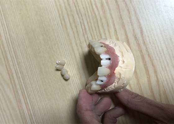 Corona exacta del implante del diente de los accesorios del implante dental de Biocompatibility