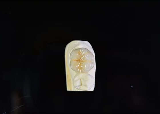 Coronas dentales de porcelana de súper resistencia con alta intermiscibilidad biológica