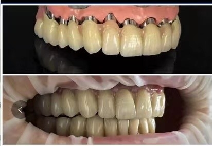 Implantes dentales Telescopio puente de porcelana PFM