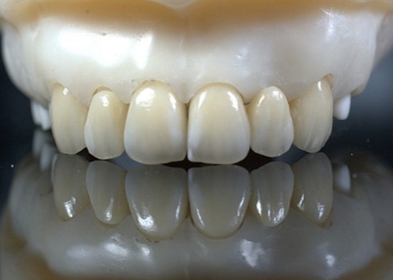 EMAX Durabilidad Carillas dentarias compuestas CAD/CAM Muy detalladas Exactas
