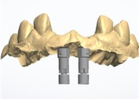 Diseño CAD/CAM preciso de corona dental de zirconia para el ajuste