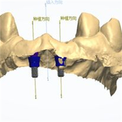 Diseño CAD/CAM preciso de corona dental de zirconia para el ajuste
