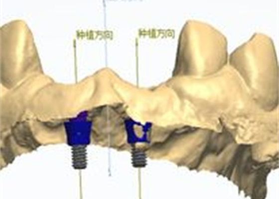 Modelo en 3D Corona de zirconio