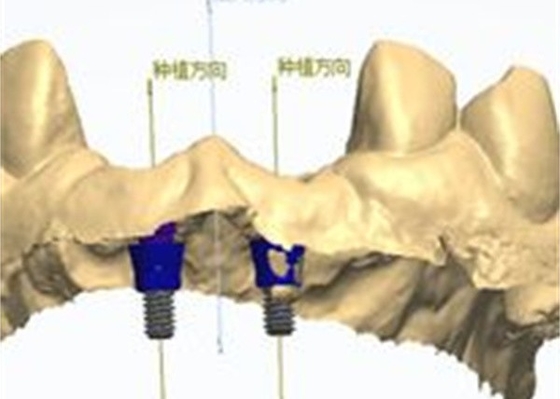 Diseño CAD/CAM preciso de corona dental de zirconia para el ajuste