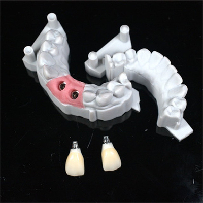 Diseño CAD/CAM preciso de corona dental de zirconia para el ajuste