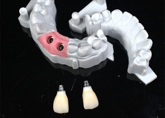 Diseño CAD/CAM preciso de corona dental de zirconia para el ajuste