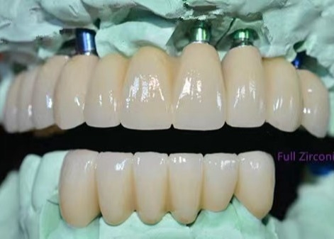 OEM Implante de zirconía de corona dental puente fijo