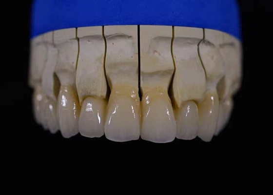 La circona dental de la restauración de la corona de la circona llena de la boca fijó resistencia química del puente
