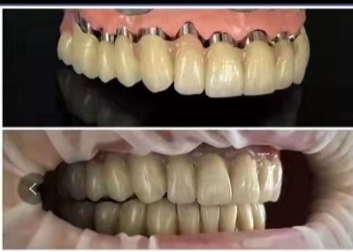 La corona telescópica 3D dental del puente de la corona del implante de la leva PFM del cad imprimió modelos