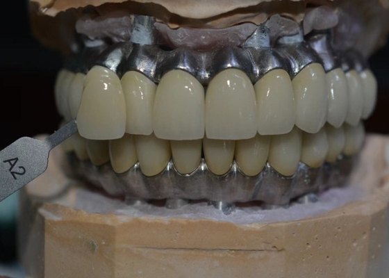 Material biológico apoyado implante resistente a la corrosión de la corona del metal del Cr del Co