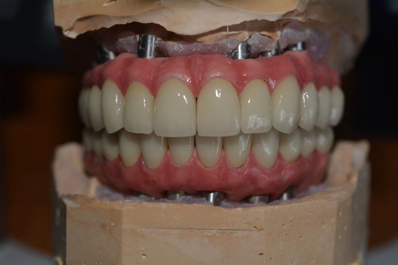 Coronas de implantes dentales de precisión para mayor comodidad y confianza