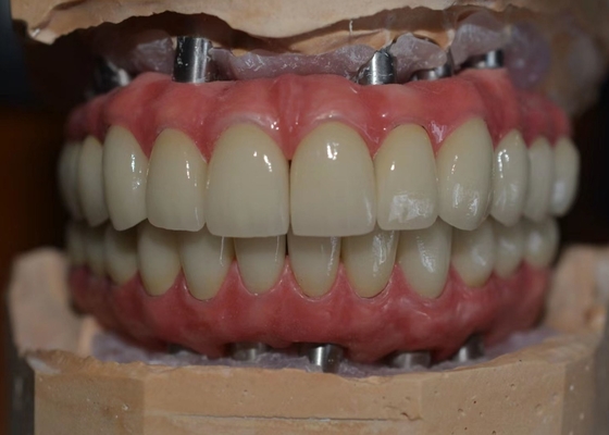Material biológico apoyado implante resistente a la corrosión de la corona del metal del Cr del Co