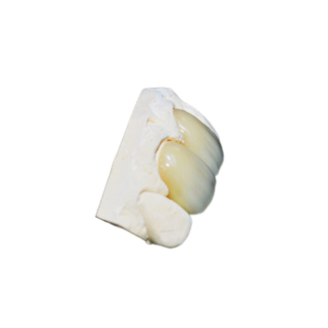 Coronas dentales de zirconia fabricadas con ayuda de computadora con color natural y alta resistencia