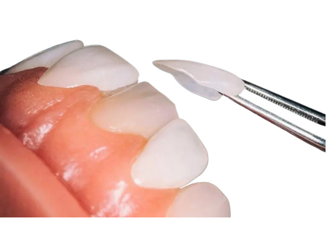 Desgaste dental de encargo de la empresa de la chapa de la porcelana del OEM - resistente para la restauración dental