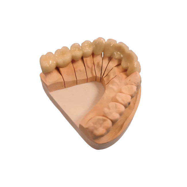 Superficie lisa del metal de la porcelana de la corona PFM de la corona del establo dental de alta resistencia del color