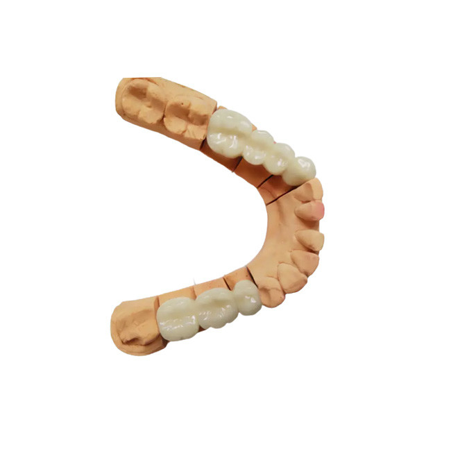 Establo de color de apariencia realista de corona dental PFM de alta calidad no es fácil de usar