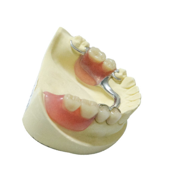 Productos dentales del laboratorio de las dentaduras de la restauración parcial desprendible de acero de la dentadura