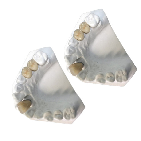 Nueva condición de la porcelana del color oro amarillo dental de alta resistencia del puente