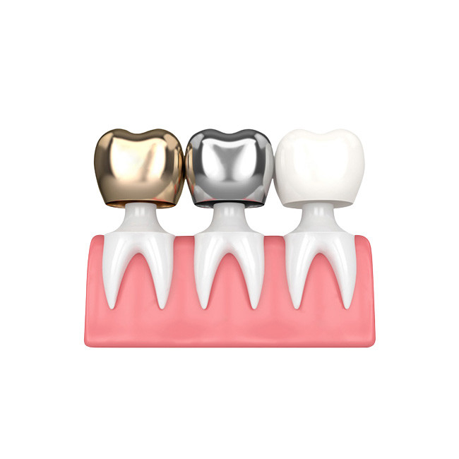 Buenas coronas y puentes dentales de Biocompatibility no fáciles llevar el establo del color