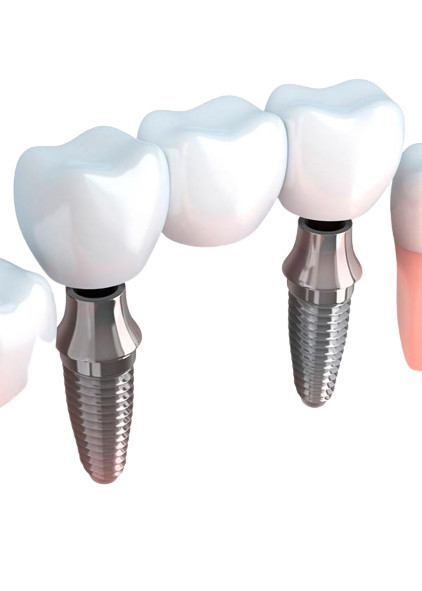 Puentes realistas del aspecto y color natural de la estabilidad fuerte dental de las coronas